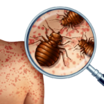 Bed Bug Bites